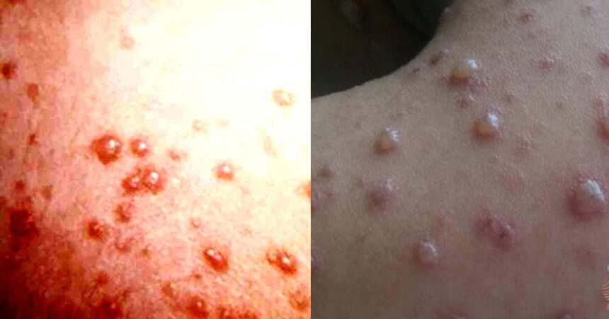 ഇടുക്കി ഉൾപ്പെടെയുള്ള ജില്ലകളിൽ ചിക്കൻ പോക്‌സ് വ്യാപനം; ലക്ഷണങ്ങൾ കണ്ടാലുടൻ ചികിത്സ തേടുക: മുൻകരുതലുകൾ ഇങ്ങനെ